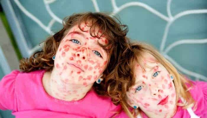 Корь у ребенка