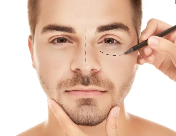 Man with marked face showing plastic surgery correction areas, close-up portrait.